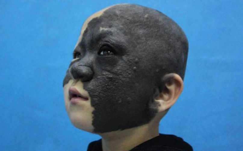 为什么医生都建议黑毛痣越早治疗越好呢?