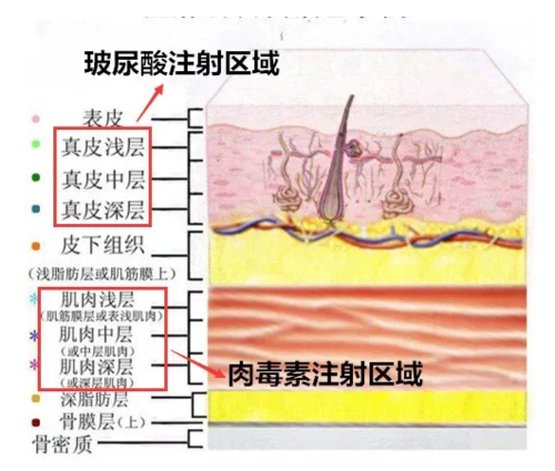 肉毒毒素需要注射至肌肉层,玻尿酸通常注射至真皮层