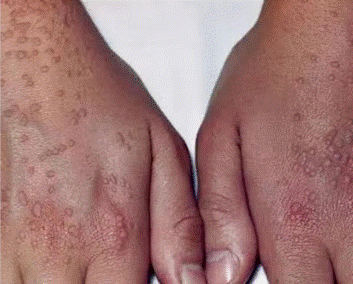 首先,扁平疣也是由hpv病毒感染引起来的,但是,得了扁平疣不见得就会在