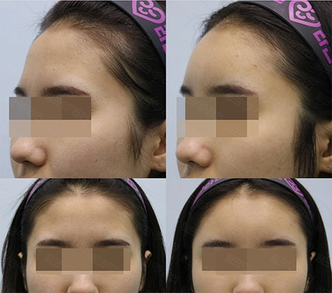 额头填充手术前后对比图