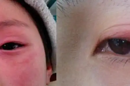 【图】眼睛发炎图片展示 教你轻松评估病因