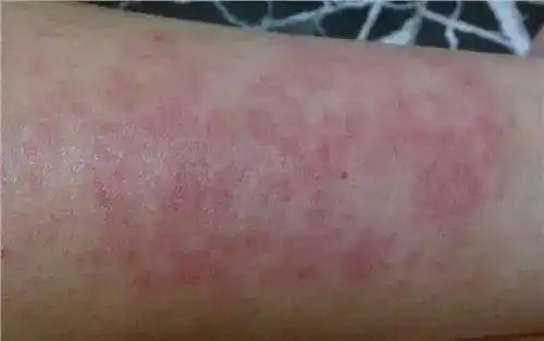 重点湿疹荨麻疹都是皮肤过敏如何区别治疗斩草除根