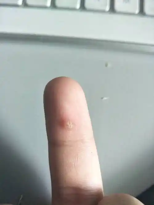 手上有个茧,按了不疼,就是搁着难受,用剪刀剪过,过一阵子又出来了,有