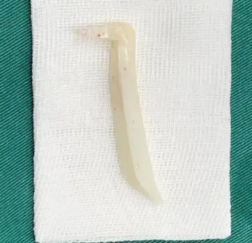 【老李说鼻子】这两天的手术,都是l形硅胶假体术后修_圈子-新氧美容