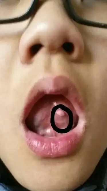 舌头下面有个小肉球是什么东西