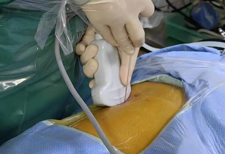 —充满"变数"的多通道经皮肾镜碎石术