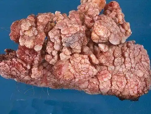 质硬,内向生长,可形成扁平溃疡向深部浸润,晚期癌肿可侵及丁丁海绵体