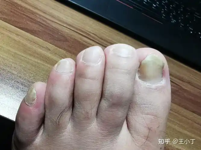 记录治疗灰指甲疗程效果