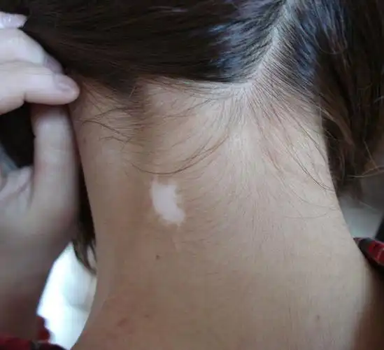 白癜风症状_白癜风早期症状-人康皮肤病医院