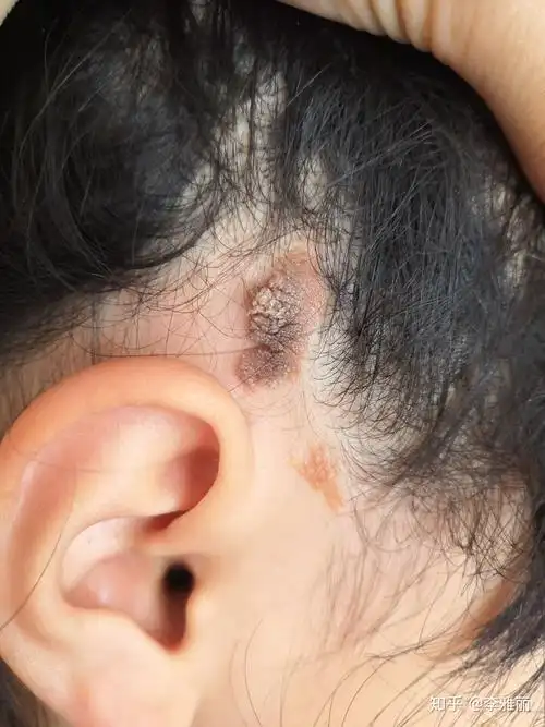 八周岁女童治疗皮脂腺痣全过程