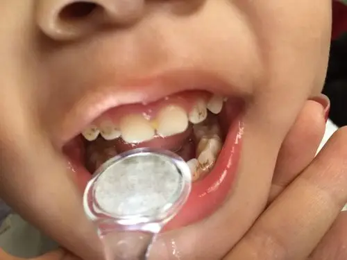 急急急!应该是牙菌斑