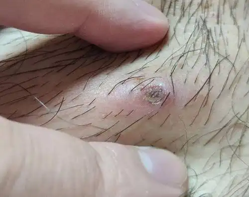 火疖子自行溃破自己在家消毒排