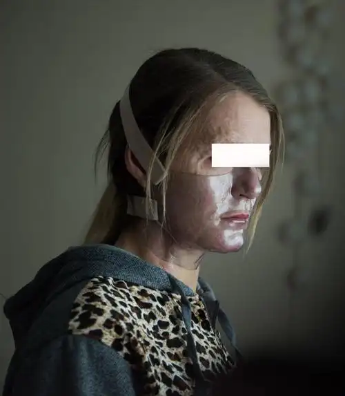 烧伤后疤痕增生的费用德国萨克森烧伤中心2