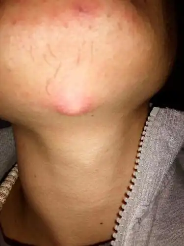 下巴下面长了个淋巴结.明天想去医院看看.明天是周六.这种疙瘩必须需