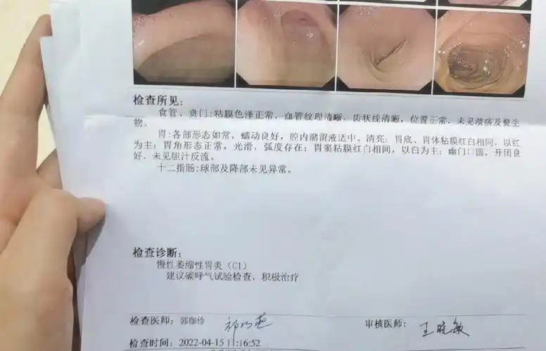 普通胃镜过程分享