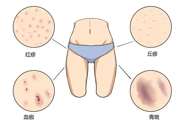 如何判断是否得了阴虱病