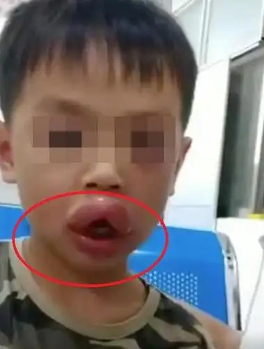 萌娃吃葡萄过敏,嘴巴肿成"嘟嘟嘴",网友:忍不住想笑!