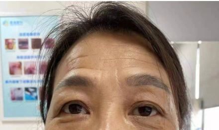 左眼轻度上睑下垂术后1月(muller肌缩短)