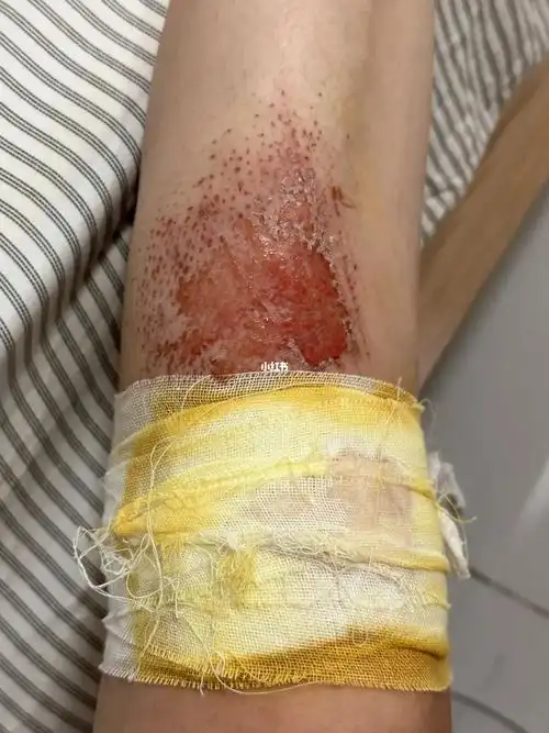 第三天去医院包了绷带纱布