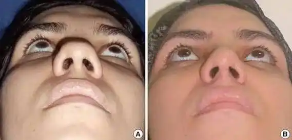 鼻翼不对称矫正手术的步骤是什么呢?_整好名医