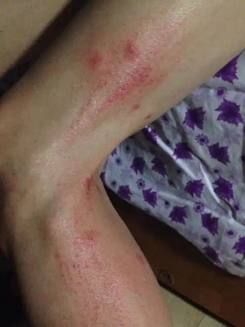 想问问在草丛中被虫子咬了,然后非常痒,还起了红色的包,很大,怎么办?