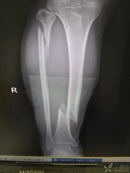 1月后的胫骨骨折什么弄