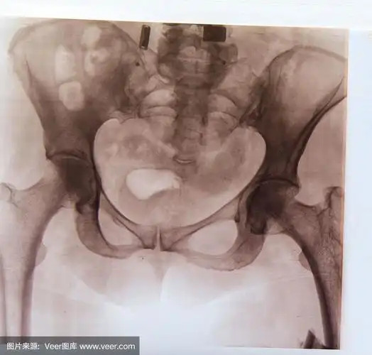 骨盆,x射线