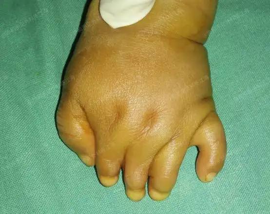 发布时间:2022-07-11753次浏览江海科普宝宝双手复杂并指"粘连"严重