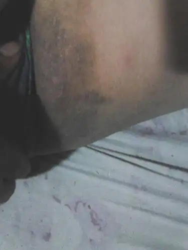 本人从事厨房,人比较胖,大腿内侧黑黑的,不知道为什么会这样!