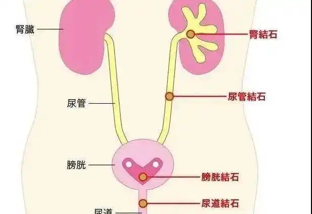 其中,以肾及输尿管结石最常见.