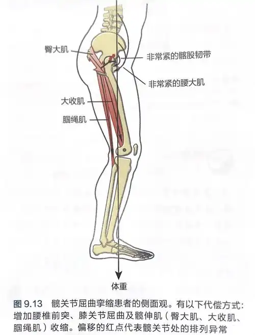 临床见解髋关节屈曲挛缩预防技巧