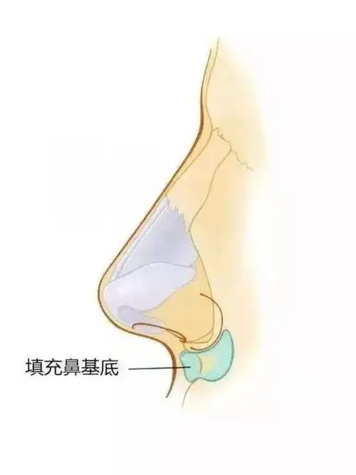 鼻基底凹陷严重什么材料填充比较好