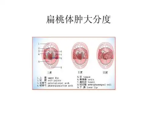 扁桃体肿大分度图片