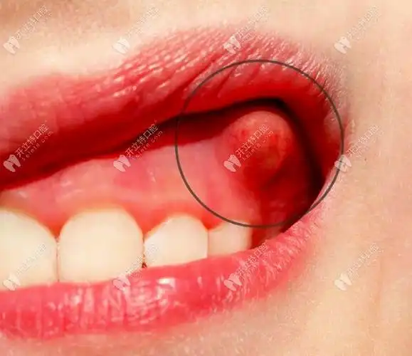 牙龈长脓包是怎么回事自己用针扎破或者挤破行吗