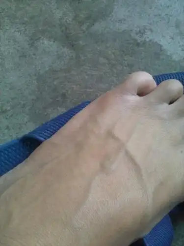 脚上的经鼓起来,怎么回事,是不是静脉曲张啊,怎么治疗呀,今年19岁