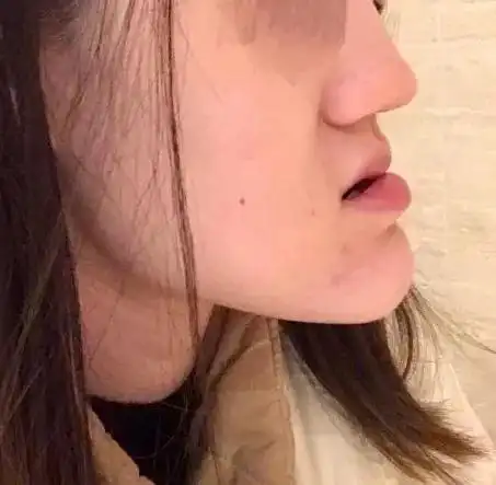 都说矫正要趁早,成年后地包天还有救吗?