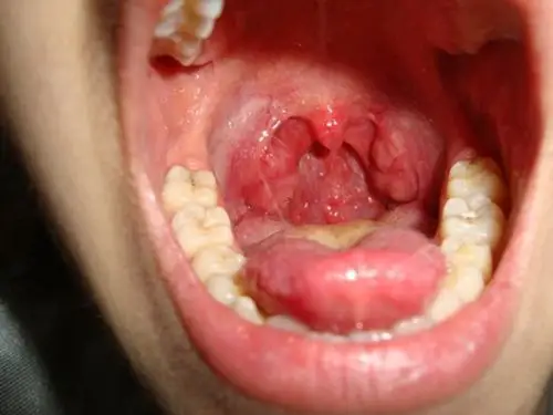 扁桃体肿大图片9