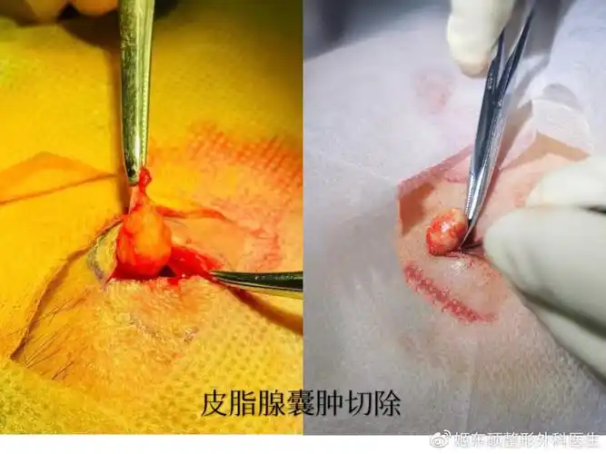 发现长了皮脂腺囊肿怎么办?