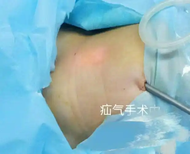 小儿疝气,真的"so easy"