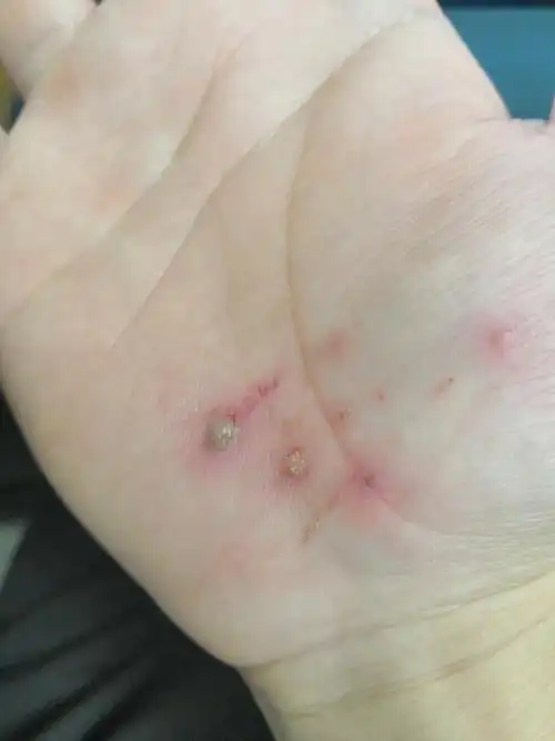 骑车摔跤手擦破,泥水沙子进入伤口,有大碍吗?