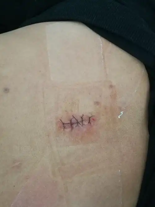 外院背部皮脂腺囊肿术后复发美容科手术治疗 - 好大夫在线