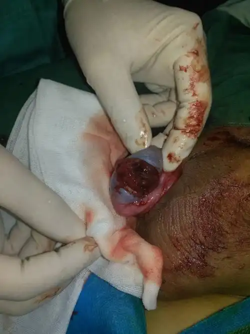 切开睾丸,可见血肿和活动性出血.清除血肿,彻底止血.