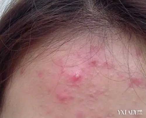 脸上长了青春痘怎么办 应该如何处理青春痘