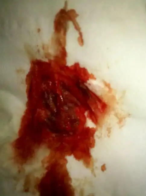 投诉 答: 病情分析: 月经血一般呈暗红色,不凝固,除血液外,还含有