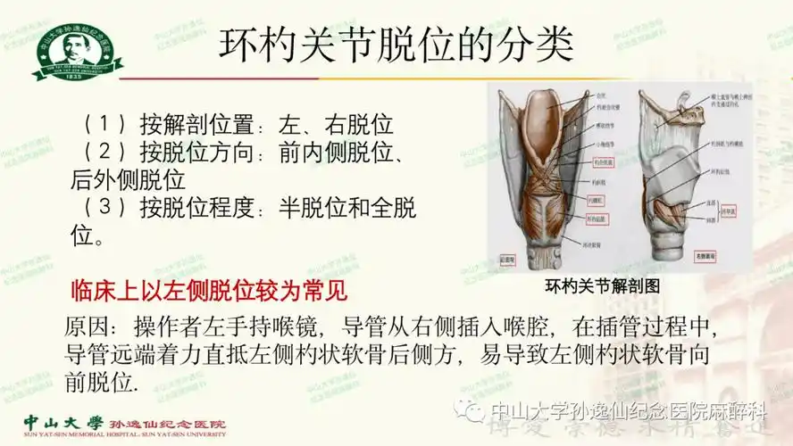 麻醉视角 | 术后环杓关节脱位的防治(中山大学孙逸仙纪念医院)_杜素娟