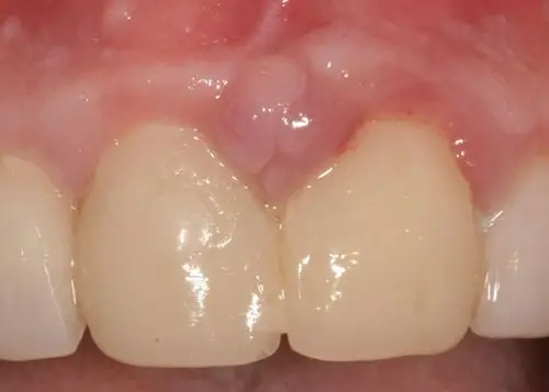 牙癌图片 (44)_有来医生