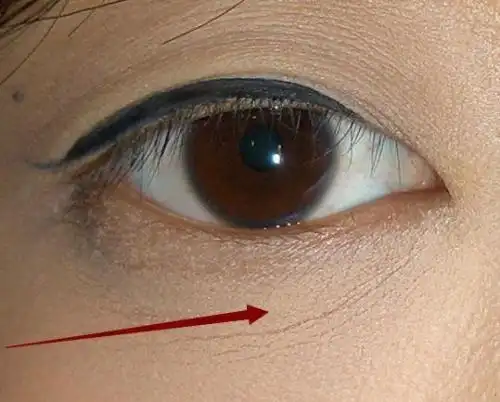 眼部干纹怎么去如何区分干纹细纹皱纹