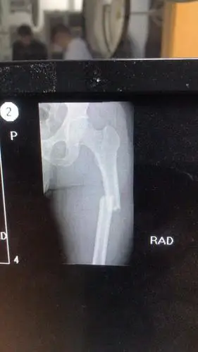 "90后刑警为追捕盗窃嫌犯大腿骨折