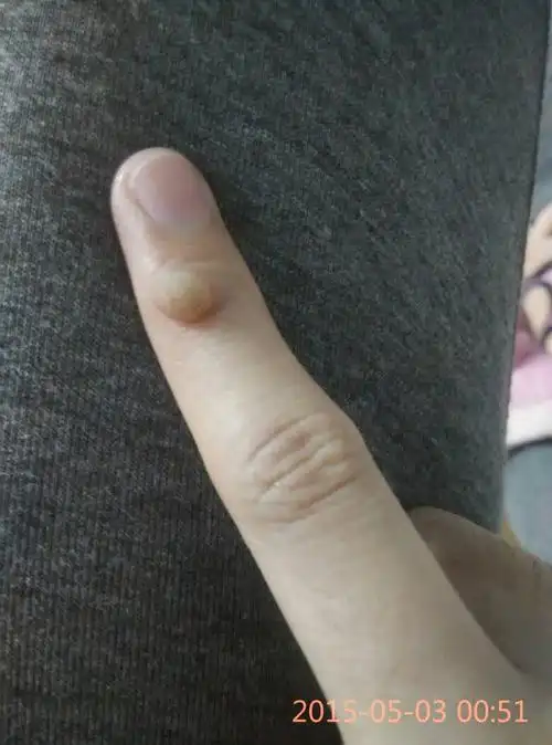 几个月,食指莫名其妙长出个硬疙瘩,,不痛不痒,,偶尔按压有点点疼,,这