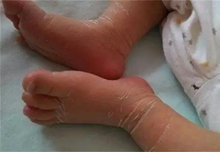 小孩手足癣是什么原因引起的